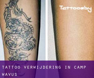 Tattoo verwijdering in Camp Wavus