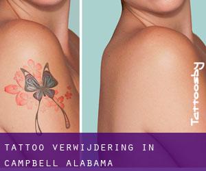 Tattoo verwijdering in Campbell (Alabama)