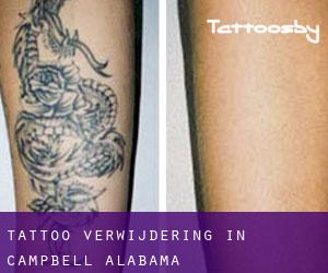 Tattoo verwijdering in Campbell (Alabama)