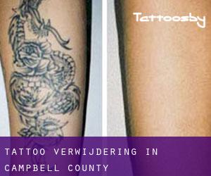 Tattoo verwijdering in Campbell County