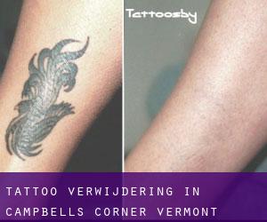 Tattoo verwijdering in Campbells Corner (Vermont)
