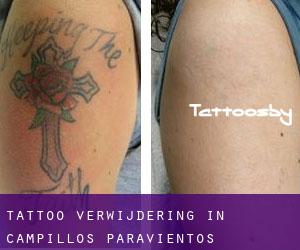 Tattoo verwijdering in Campillos-Paravientos