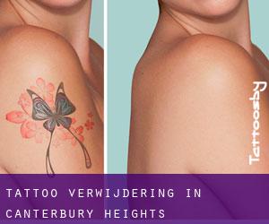 Tattoo verwijdering in Canterbury Heights