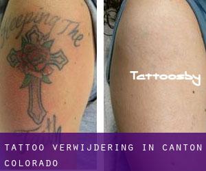 Tattoo verwijdering in Canton (Colorado)
