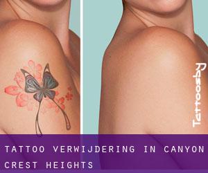 Tattoo verwijdering in Canyon Crest Heights