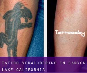 Tattoo verwijdering in Canyon Lake (California)