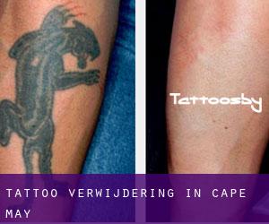Tattoo verwijdering in Cape May