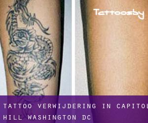 Tattoo verwijdering in Capitol Hill (Washington, D.C.)