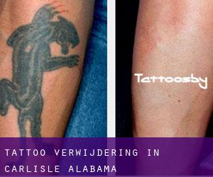 Tattoo verwijdering in Carlisle (Alabama)