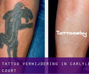 Tattoo verwijdering in Carlyle Court