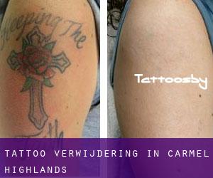 Tattoo verwijdering in Carmel Highlands