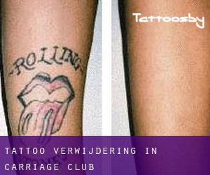 Tattoo verwijdering in Carriage Club