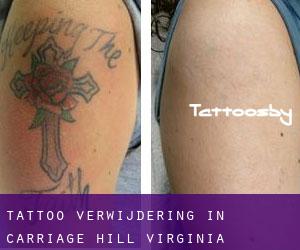 Tattoo verwijdering in Carriage Hill (Virginia)