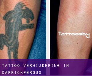 Tattoo verwijdering in Carrickfergus
