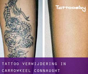 Tattoo verwijdering in Carrowkeel (Connaught)