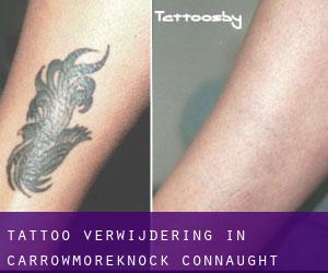 Tattoo verwijdering in Carrowmoreknock (Connaught)