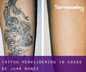 Tattoo verwijdering in Casas de Juan Núñez