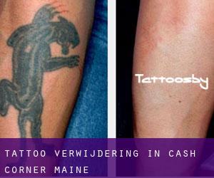Tattoo verwijdering in Cash Corner (Maine)
