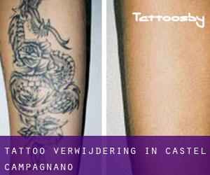 Tattoo verwijdering in Castel Campagnano