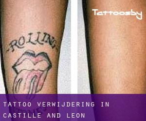 Tattoo verwijdering in Castille and León