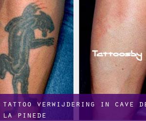 Tattoo verwijdering in Cave de la Pinède