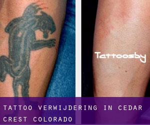 Tattoo verwijdering in Cedar Crest (Colorado)