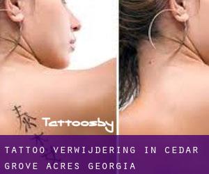 Tattoo verwijdering in Cedar Grove Acres (Georgia)