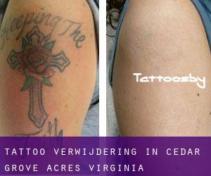 Tattoo verwijdering in Cedar Grove Acres (Virginia)