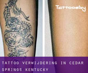 Tattoo verwijdering in Cedar Springs (Kentucky)
