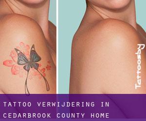 Tattoo verwijdering in Cedarbrook County Home