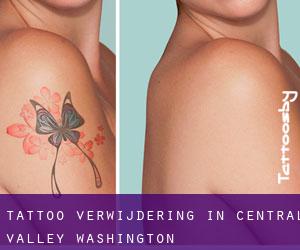 Tattoo verwijdering in Central Valley (Washington)