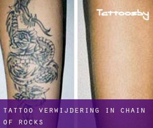 Tattoo verwijdering in Chain of Rocks