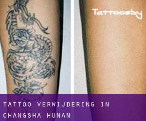 Tattoo verwijdering in Changsha (Hunan)