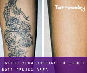 Tattoo verwijdering in Chante-Bois (census area)