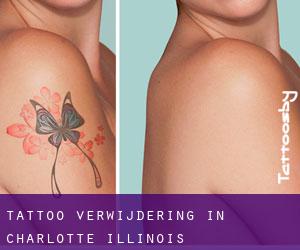 Tattoo verwijdering in Charlotte (Illinois)