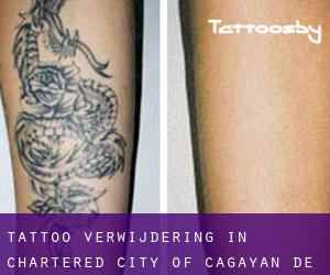 Tattoo verwijdering in Chartered City of Cagayan de Oro