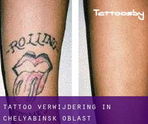 Tattoo verwijdering in Chelyabinsk Oblast