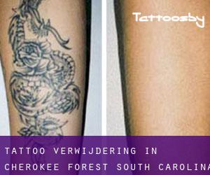 Tattoo verwijdering in Cherokee Forest (South Carolina)