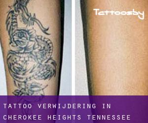 Tattoo verwijdering in Cherokee Heights (Tennessee)
