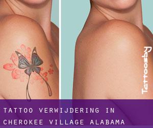 Tattoo verwijdering in Cherokee Village (Alabama)