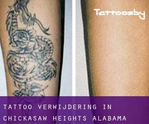 Tattoo verwijdering in Chickasaw Heights (Alabama)