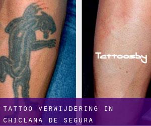 Tattoo verwijdering in Chiclana de Segura
