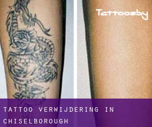 Tattoo verwijdering in Chiselborough