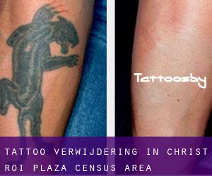 Tattoo verwijdering in Christ-Roi-Plaza (census area)