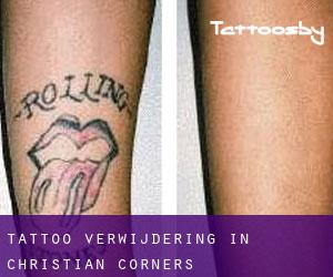 Tattoo verwijdering in Christian Corners
