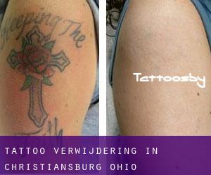 Tattoo verwijdering in Christiansburg (Ohio)