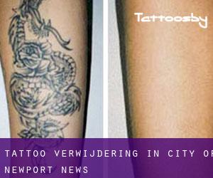 Tattoo verwijdering in City of Newport News