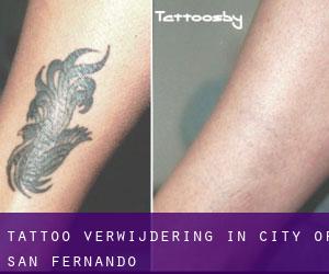 Tattoo verwijdering in City of San Fernando