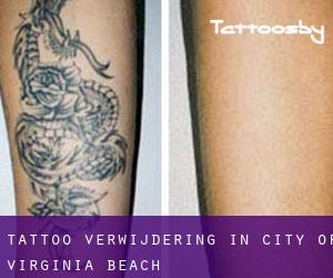 Tattoo verwijdering in City of Virginia Beach