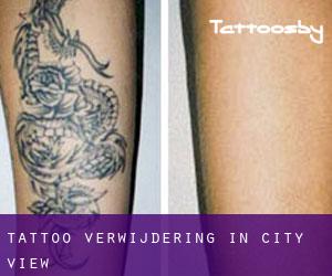 Tattoo verwijdering in City View